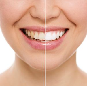 teeth whitening patient