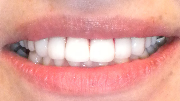 Veneers After