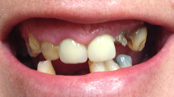 implant restorations before