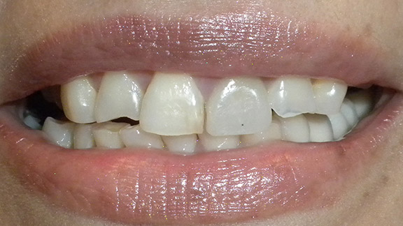 Veneers Before